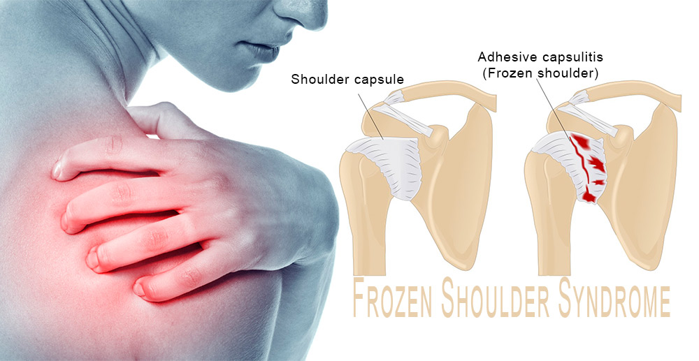 Understanding Frozen Shoulder: A Common Cause of Shoulder Pain Understanding Frozen Shoulder: A Common Cause of Shoulder Pain