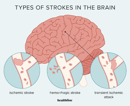 Types of Stroke in the Brain